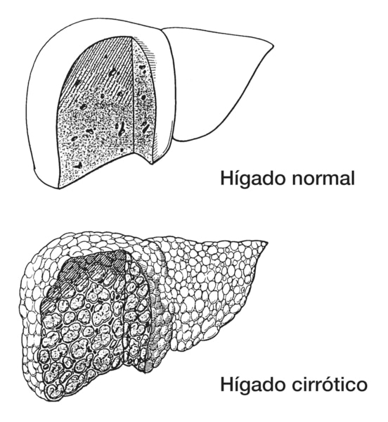 El primer dibujo muestra una porción normal de tejido hepático. El segundo dibujo muestra una porción de tejido hepático cirrótico.
