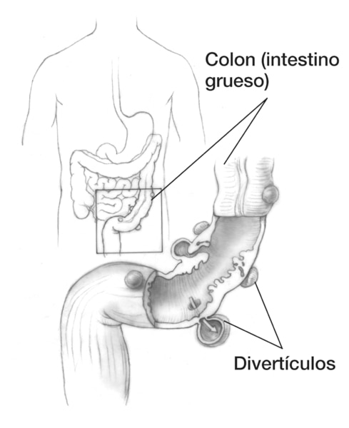 Dibujo del colon y el agrandamiento del colon mostrando divertículos en el colon (intestino grueso); se señalan a los divertículos y al colon.