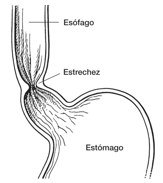 Dibujo de una estrechez, o angostura, en la que se señala el esófago, estrechez y estómago.