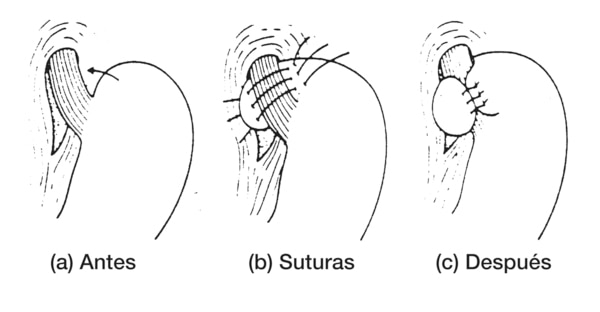 Dibujo del estómago y esófago antes de la operación de fundoplicatura de Nissen, con suturas, y después de la operación de fundoplicatura de Nissen.