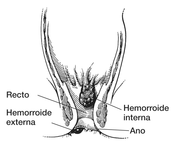 Dibujo del recto y el ano con una hemorroide interna y una hemorroide externa señaladas.