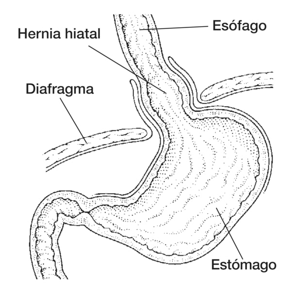 Dibujo de una hernia hiatal en la que se señala el esófago, diafragma, estómago y hernia hiatal.
