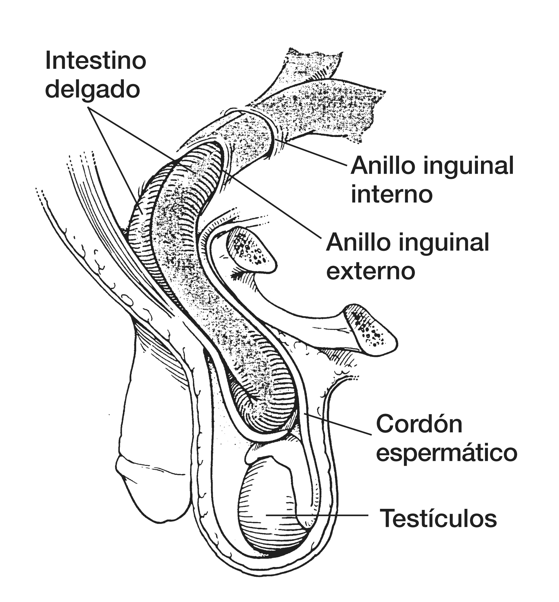 Anillo online inguinal interno