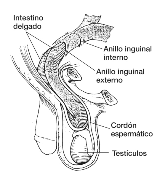 Dibujo de una hernia inguinal en la que se señala el intestino delgado, anillo inguinal interno, anillo inguinal externo, cordón espermático y testículos.