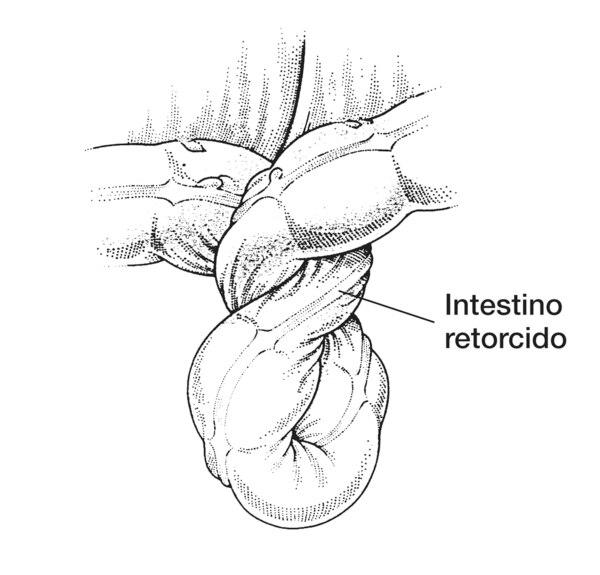 Dibujo del intestino mostrando el vólvulo o intestino retorcido. Una etiqueta señala el intestino retorcido.