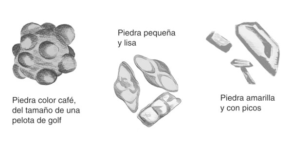 Dibujo de tres tipos de piedra en el riñón que se señalan: “Piedra color café, del tamaño de una pelota de golf”; “Piedra pequeña y lisa” y “Piedra amarilla y con picos”. La piedra del tamaño de una pelota de golf es esférica y abultada. Las piedras peque