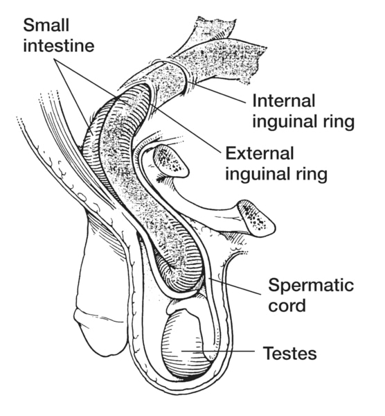 Drawing of an inguinal hernia with the small intestine, internal inguinal ring, external inguinal ring, spermatic cord, and testes labeled.