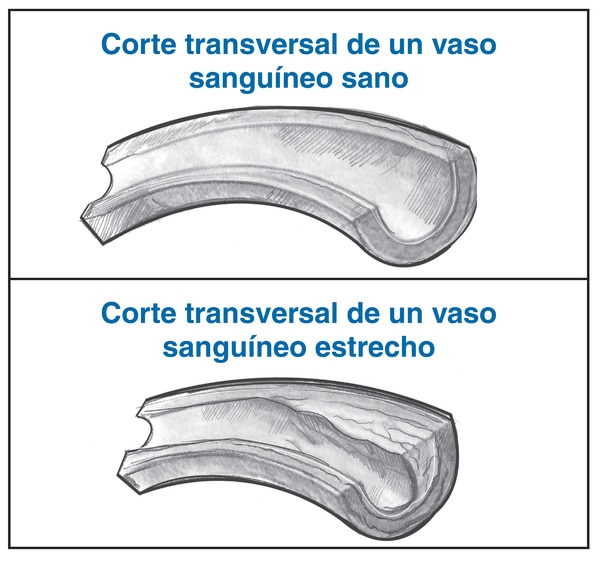 Ilustración de dos dibujos de la sección transversal de un vaso sanguíneo. El primer dibujo muestra el corte transversal de un vaso sanguíneo sano. Se etiqueta: corte transversal de un vaso sanguíneo sano. El segundo dibujo muestra el corte transversal de
