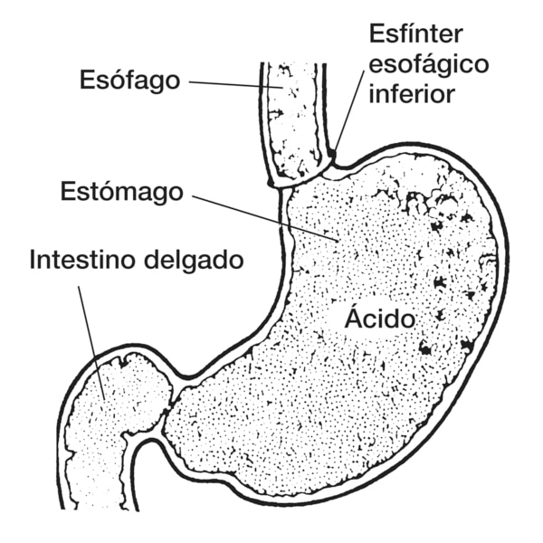 Dibujo del esfínter esofágico inferior en el que se señala el esófago, esfínter esofágico inferior, estómago con ácido y intestino delgado.