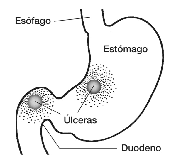 Dibujo del estómago y duodeno en el que se señala el estómago, duodeno, esófago y úlceras.