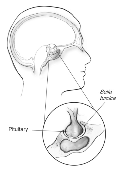 Drawing of the outline of a human head showing the location of the   pituitary gland just beneath the brain. An inset shows the pituitary gland sitting in   the sella turcica, an area of bone that surrounds the pituitary gland.