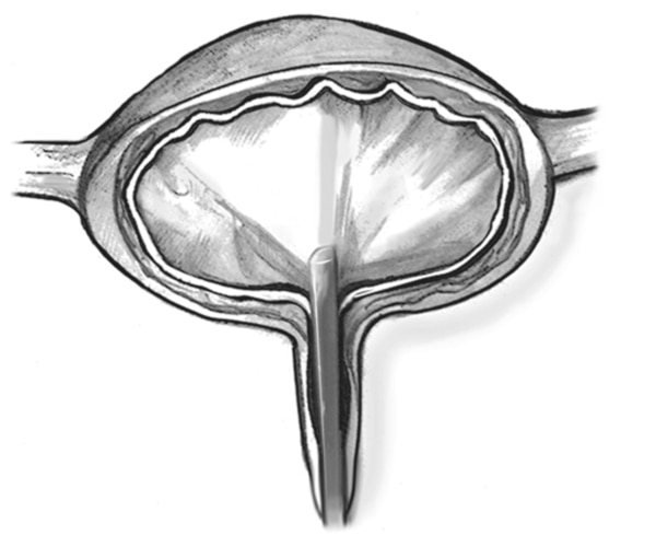 Cross-section diagram of a bladder with cystoscope visible in the urethra. An inset shows an enlarged section of the inner bladder wall where pinpoint bleeding is visible.