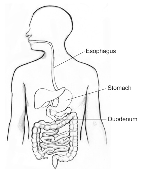 Drawing of the digestive tract with the esophagus, stomach, and duodenum labeled.