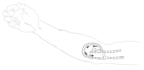 Drawing of an arm with an arteriovenous graft. A curved tube connects the artery to the vein. Arrows show the direction of blood flow from the artery to the vein.
