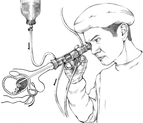 Drawing of a doctor performing a transurethral resection of the prostate. An inset shows a microscopic view of a wire loop cutting tissue from the prostate.