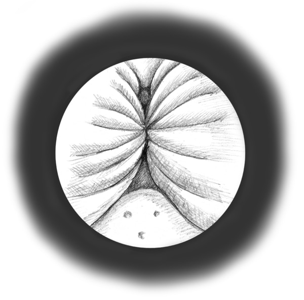 Drawing of inside of the urethra, as seen through a cystoscope. The sides of the urethra are pushed together, leaving little space for urine flow.