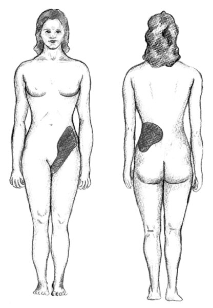 Drawings of a female figure. The lower back and waist are shaded in the back view. The pelvic region is shaded in the front view.  Shaded areas indicate where kidney stones may cause pain.