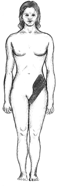 Drawing of the front side of a female figure. The pelvic region is shaded to show where kidney stones may cause pain.