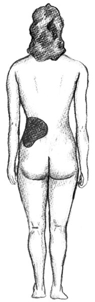 Drawing of the back side of a female figure. The lower back and waist are shaded to show where kidney stones may cause pain.