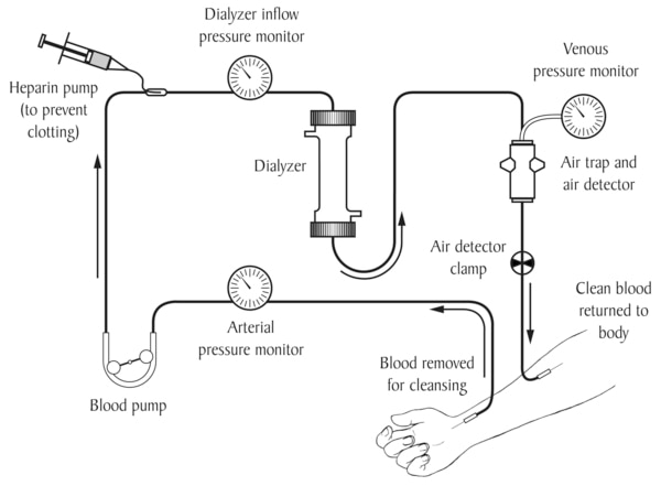Drawing of a hemodialysis circuit. Labels point to blood removed for cleansing, arterial pressure monitor, blood pump, heparin pump to prevent clotting, dialyzer, inflow pressure monitor, air detector clamp, venous pressure monitor, air trap and air detec