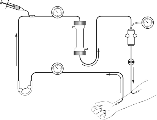 Drawing of a hemodialysis circuit.