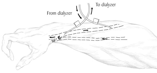 Drawing of forearm with needles inserted into the vascular access. Labels indicate one needle takes blood to the dialyzer and the other returns blood from the dialyzer.