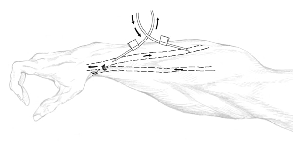 Drawing of forearm with needles inserted into the vascular access.