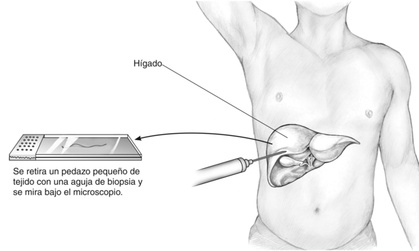 Dibujo de una biopsia hepática percutánea. Se puede observar una aguja de biopsia siendo insertada en el hígado de un hombre y se etiqueta el hígado. Una flecha apunta desde del hígado hacia una placa de microscopio que contiene un pedazo de tejido en for