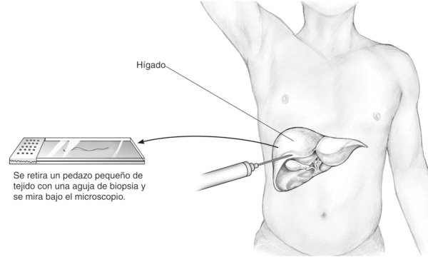 Dibujo de una biopsia hepática percutánea. Se puede observar una aguja de biopsia siendo insertada en el hígado de un hombre y se etiqueta el hígado. Una flecha apunta desde del hígado hacia una placa de microscopio que contiene un pedazo de tejido en for
