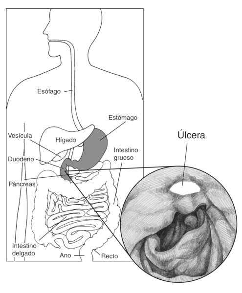 Dibujo del aparato digestivo en la que se señalan el esófago, estómago, hígado, vesícula, duodeno, páncreas, intestino delgado, intestino grueso, recto y ano. Un dibujo agrandado del estómago muestra una úlcera péptica en la que se señala la úlcera.
