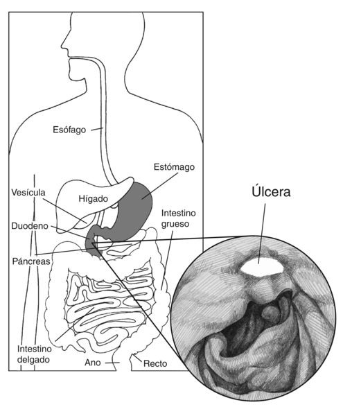 Dibujo del aparato digestivo en la que se señalan el esófago, estómago, hígado, vesícula, duodeno, páncreas, intestino delgado, intestino grueso, recto y ano. Un dibujo agrandado del estómago muestra una úlcera péptica en la que se señala la úlcera.