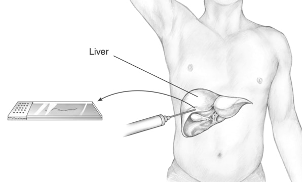 Drawing of a liver biopsy procedure. A liver is drawn within an outline of a male body. A needle pricks a piece of the liver tissue. An arrow points away from the spot where the needle touches the liver toward a slide with the tissue sample. The liver is