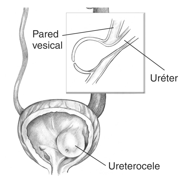 Ilustración de la toma frontal de una vejiga y uréter mostrando un ureterocele. El ureterocele se encuentra inflamado. Se muestra un corte transversal de la vejiga para detallar que el uréter se extiende hacia la parte interior de la vejiga. Un recuadro m