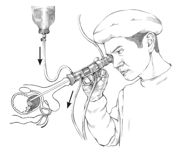 Ilustración de un médico realizando una resección transuretral de la próstata. Las flechas a los lados muestran la dirección del agua que fluye hacia el cistoscopio y de regreso hacia afuera.