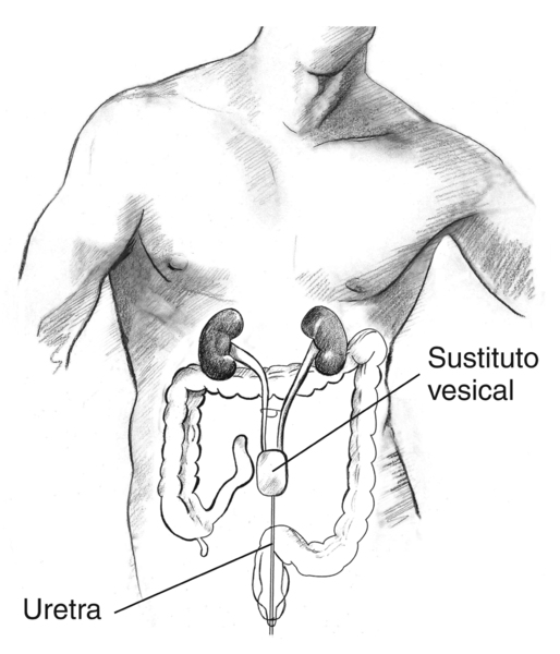 Ilustración de un cuerpo masculino con el tracto urinario y el colon visibles dentro del abdomen. Se ha creado un sustituto vesical encima de la ubicación de la vejiga normal. Una uretra artificial conecta el sustituto vesical con la uretra normal para qu
