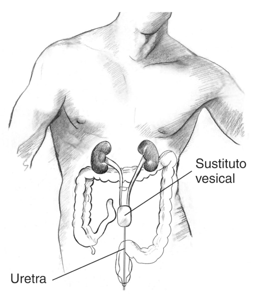 Ilustración de un cuerpo masculino con el tracto urinario y el colon visibles dentro del abdomen. Se ha creado un sustituto vesical encima de la ubicación de la vejiga normal. Una uretra artificial conecta el sustituto vesical con la uretra normal para qu