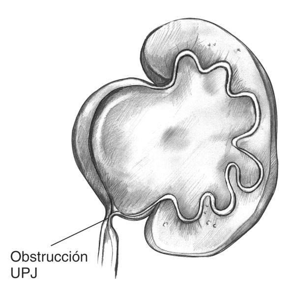 Ilustración de la obstrucción de la unión ureteropélvica (UPJ en inglés). El bloqueo se presenta en el lugar donde se conecta el riñón y el uréter. Como resultado, el riñon se inflama. Se identifica al lugar de la inflamación como obstrucción UPJ.