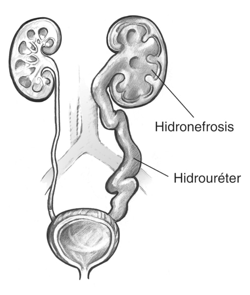 Ilustración de la toma frontal del tracto urinario que muestra obstrucción. Hay hinchazón en uno de los riñones y en la uretra. Se identifica el riñón hinchado como hidronefrosis. Se identifica el uréter inflamado como hidrouréter.