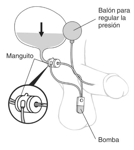 Ilustración de un esfínter urinario artificial para tratar la incontinencia urinaria masculina. Se identifica la bomba en el escroto, el manguito alrededor de la uretra y un balón para regular la presión dentro de la vejiga. Una toma agrandada muestra el