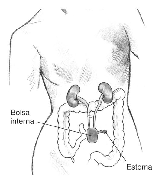 Ilustración de un cuerpo femenino con el tracto urinario y el colon visibles dentro del abdomen. Se ha creado una bolsa dentro del cuerpo llamado derivación cutánea continente que retiene a la orina, la cual se vacia a través de un agujero en la piel llam