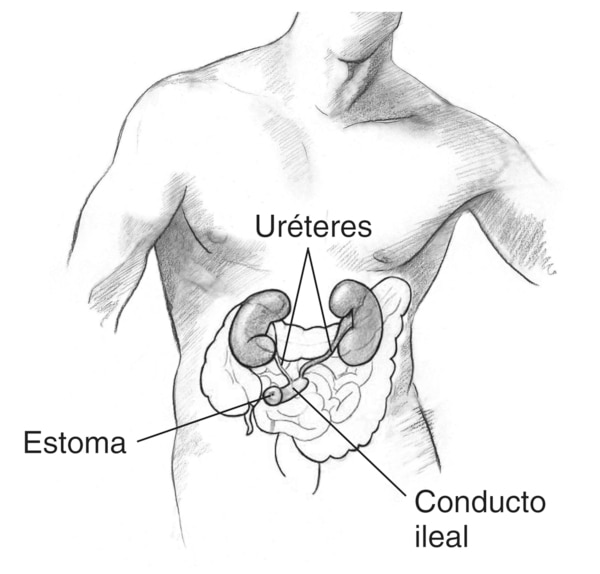 Ilustración de una silueta masculina con el tracto urinario y los intestinos visibles en el abdomen. Los uréteres se conectan directamente al conducto, o tubo, creado del colon. El conducto dirige a la orina directamente a un agujero en la piel llamado es