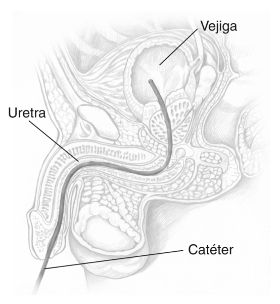 Ilustración de pérfil del tracto urinario masculino con el catéter introducido a través de la uretra a la vejiga. Las etiquetas identifican el catéter, la uretra y la vejiga.