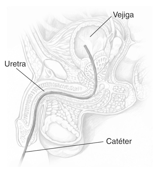 Ilustración de pérfil del tracto urinario masculino con el catéter introducido a través de la uretra a la vejiga. Las etiquetas identifican el catéter, la uretra y la vejiga.
