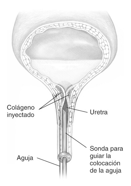Ilustración de una vejiga y uretra superior. Una inyección introducida a través de la uretra proporciona colágeno hacia el tejido alrededor de la apertura de la uretra. Se identifica el colágeno inyectado, la uretra, la sonda para guiar la colocación de l