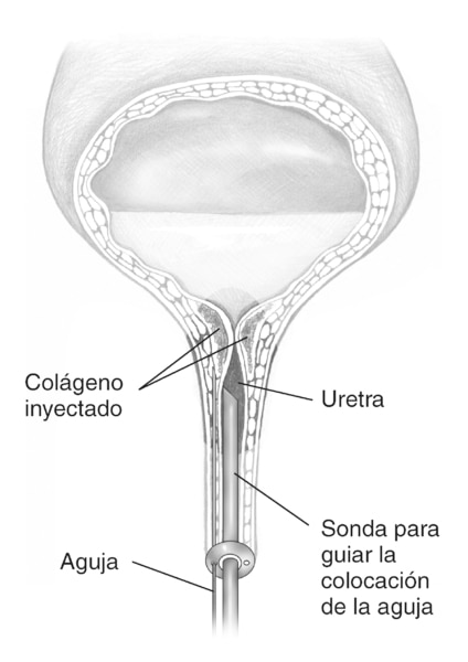 Ilustración de una vejiga y uretra superior. Una inyección introducida a través de la uretra proporciona colágeno hacia el tejido alrededor de la apertura de la uretra. Se identifica el colágeno inyectado, la uretra, la sonda para guiar la colocación de l