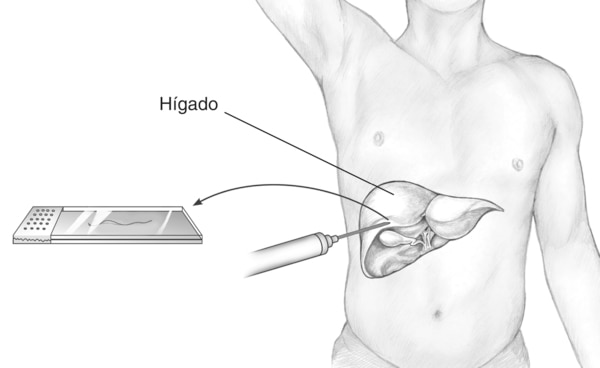 Ilustración de un procedimiento de hígado. Se ilustra un hígado dentro de la silueta de un cuerpo masculino. Una flecha apunta hacia afuera del área donde la aguja toca el hígado a una placa con una muestra de tejido. Se etiqueta el hígado.