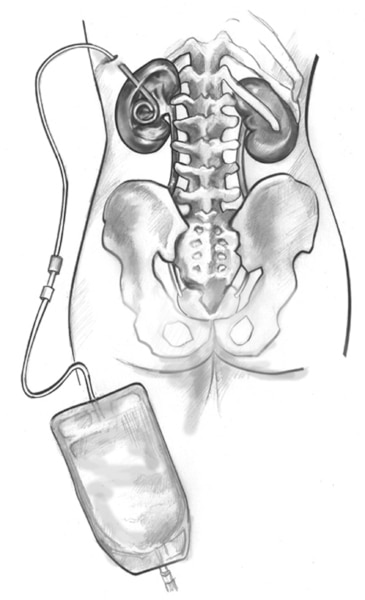 Drawing of a nephrostomy tube with the kidney, nephrostomy tube, and urine collection bag. The curled end of the nephrostomy tube is within the left kidney. The nephrostomy tube exits the body through the skin. A urine collection bag is connected to the e
