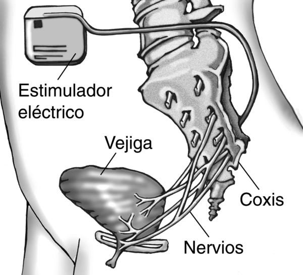 Dibujo anatómico que muestra la colocación del implante de un aparato de estimulación de los nervios en la parte baja del abdomen de una paciente mujer. Se señala el estimulador eléctrico, la vejiga, el coxis y los nervios.