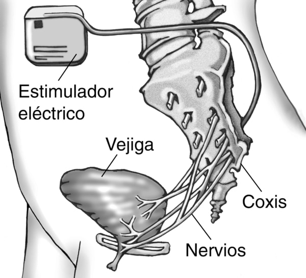 Dibujo anatómico que muestra la colocación del implante de un aparato de estimulación de los nervios en la parte baja del abdomen de una paciente mujer. Se señala el estimulador eléctrico, la vejiga, el coxis y los nervios.