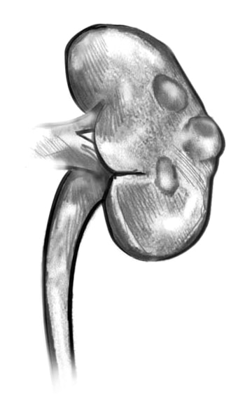 Drawing of one of the kidneys shows simple cysts as raised bumps on the kidney.